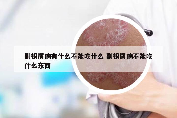 副银屑病有什么不能吃什么 副银屑病不能吃什么东西
