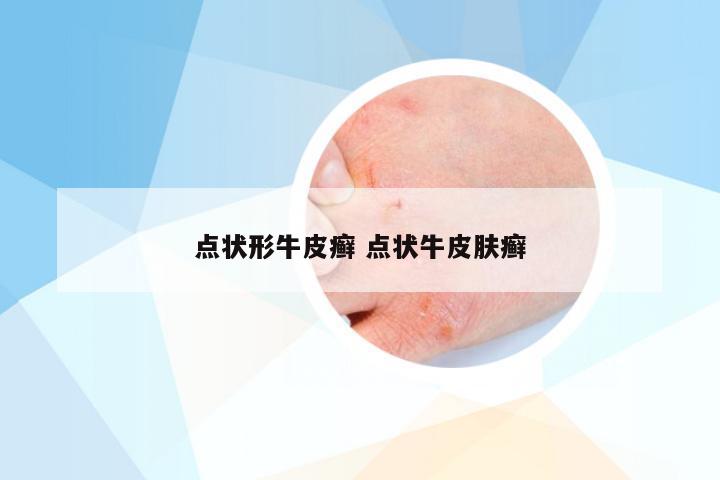 点状形牛皮癣 点状牛皮肤癣