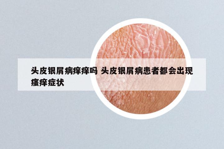 头皮银屑病痒痒吗 头皮银屑病患者都会出现瘙痒症状