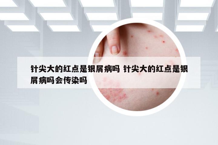 针尖大的红点是银屑病吗 针尖大的红点是银屑病吗会传染吗
