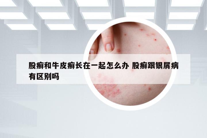 股癣和牛皮癣长在一起怎么办 股癣跟银屑病有区别吗
