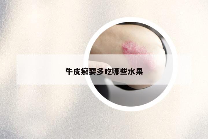 牛皮癣要多吃哪些水果