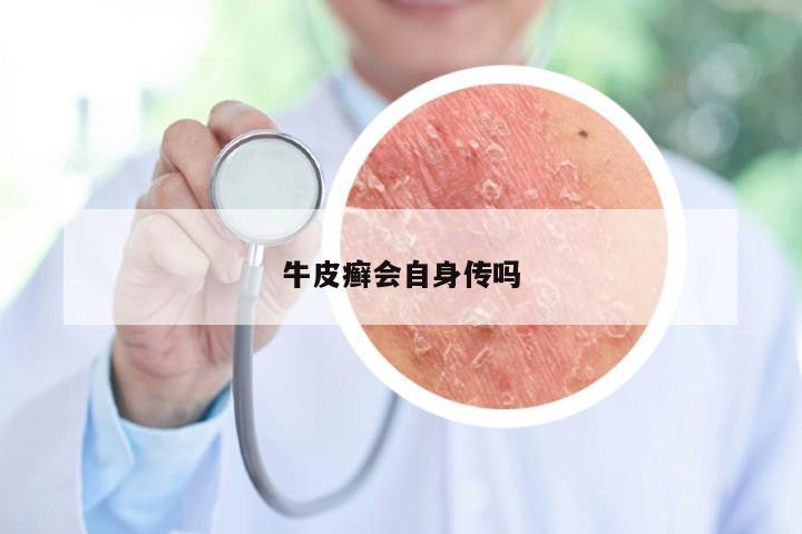 牛皮癣会自身传吗