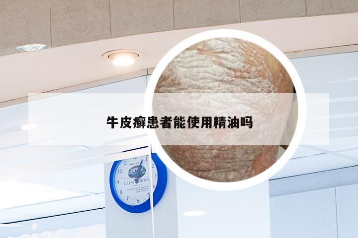 牛皮癣患者能使用精油吗