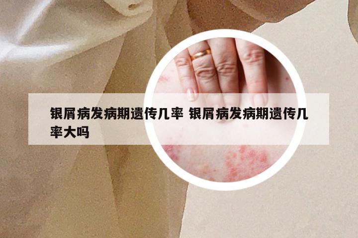 银屑病发病期遗传几率 银屑病发病期遗传几率大吗
