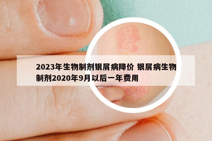 2023年生物制剂银屑病降价 银屑病生物制剂2020年9月以后一年费用