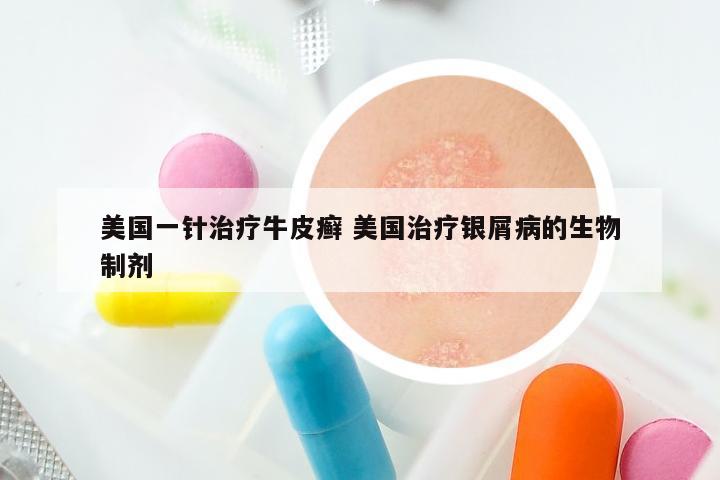 美国一针治疗牛皮癣 美国治疗银屑病的生物制剂