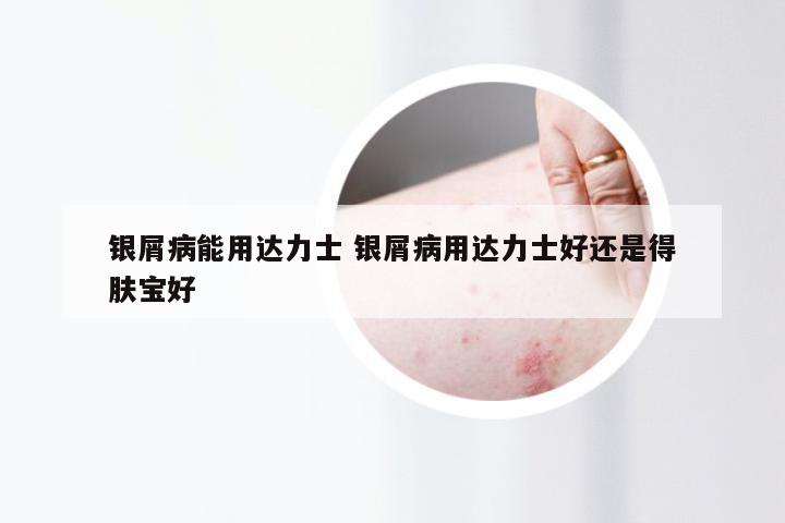 银屑病能用达力士 银屑病用达力士好还是得肤宝好