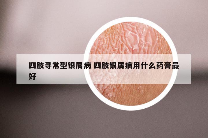 四肢寻常型银屑病 四肢银屑病用什么药膏最好