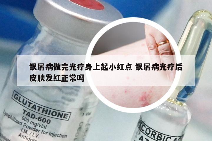 银屑病做完光疗身上起小红点 银屑病光疗后皮肤发红正常吗