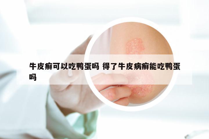 牛皮癣可以吃鸭蛋吗 得了牛皮病癣能吃鸭蛋吗