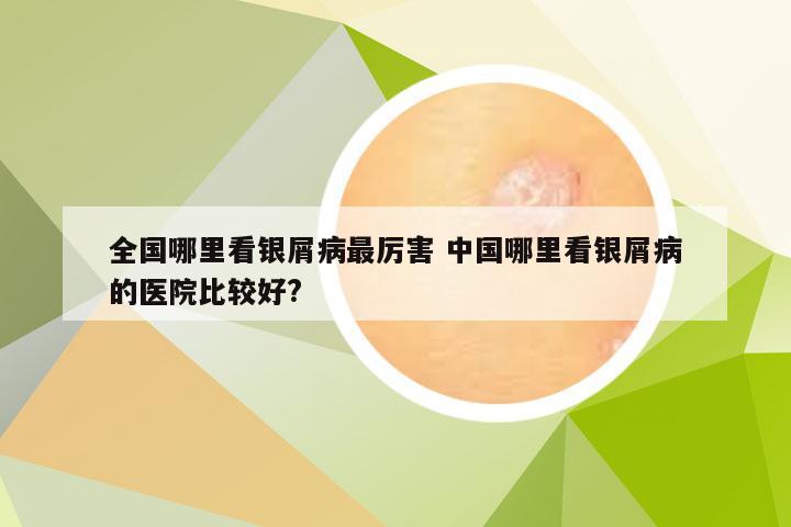全国哪里看银屑病最厉害 中国哪里看银屑病的医院比较好?