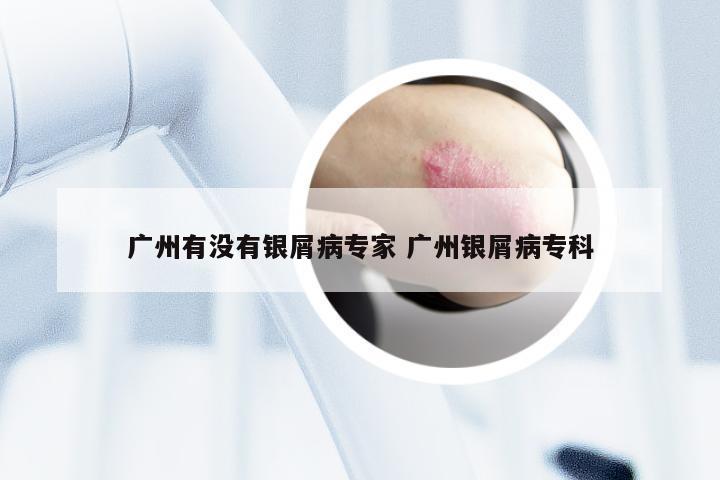 广州有没有银屑病专家 广州银屑病专科