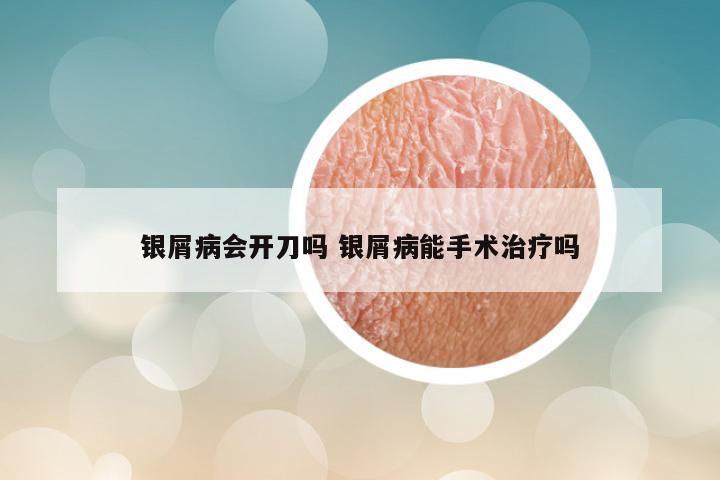 银屑病会开刀吗 银屑病能手术治疗吗