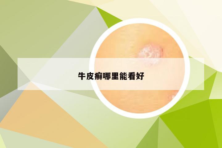 牛皮癣哪里能看好