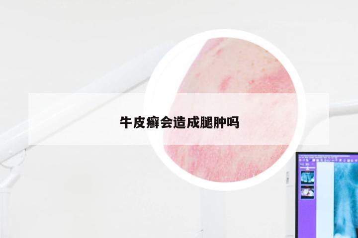 牛皮癣会造成腿肿吗