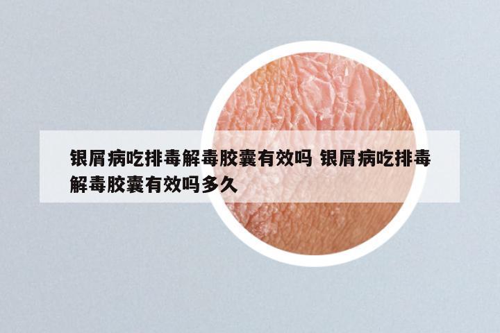 银屑病吃排毒解毒胶囊有效吗 银屑病吃排毒解毒胶囊有效吗多久