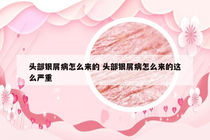 头部银屑病怎么来的 头部银屑病怎么来的这么严重