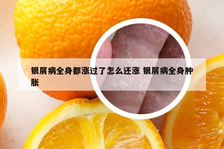 银屑病全身都涨过了怎么还涨 银屑病全身肿胀