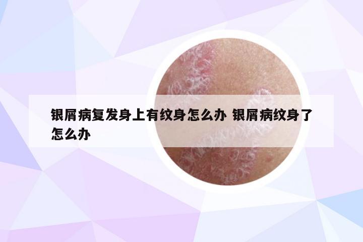 银屑病复发身上有纹身怎么办 银屑病纹身了怎么办