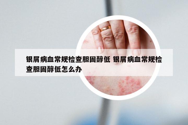 银屑病血常规检查胆固醇低 银屑病血常规检查胆固醇低怎么办