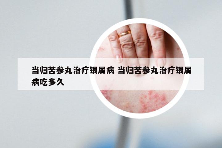 当归苦参丸治疗银屑病 当归苦参丸治疗银屑病吃多久