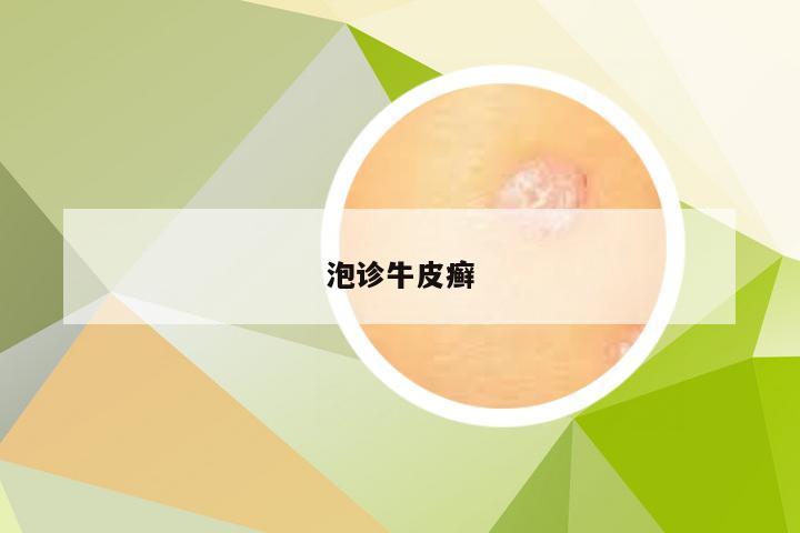 泡诊牛皮癣