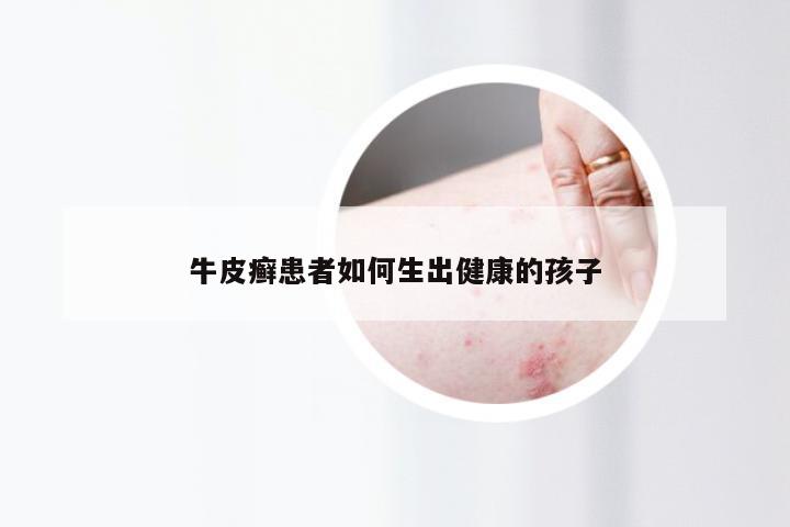 牛皮癣患者如何生出健康的孩子