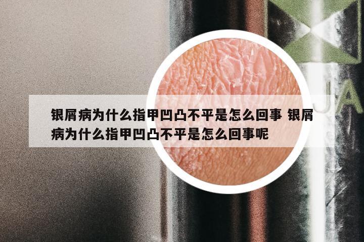 银屑病为什么指甲凹凸不平是怎么回事 银屑病为什么指甲凹凸不平是怎么回事呢