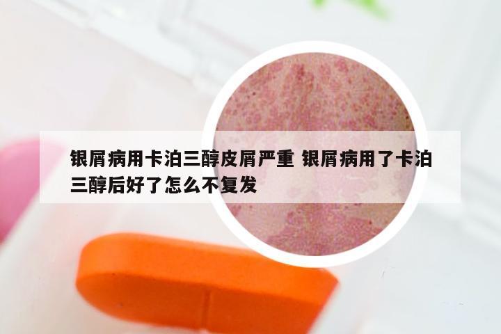 银屑病用卡泊三醇皮屑严重 银屑病用了卡泊三醇后好了怎么不复发