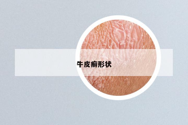 牛皮癣形状