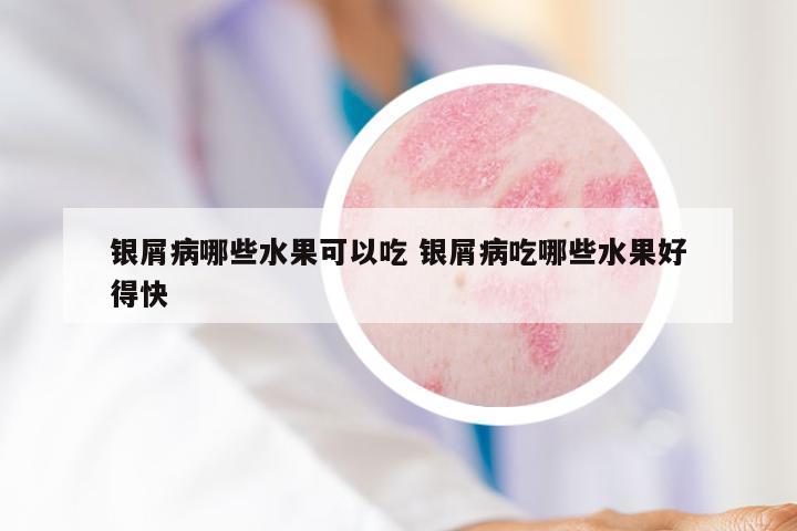 银屑病哪些水果可以吃 银屑病吃哪些水果好得快