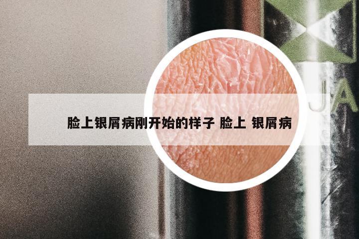 脸上银屑病刚开始的样子 脸上 银屑病
