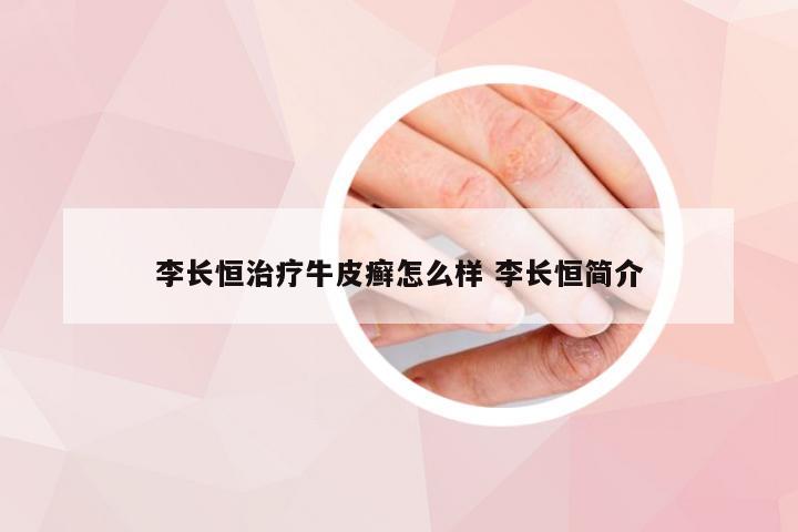 李长恒治疗牛皮癣怎么样 李长恒简介