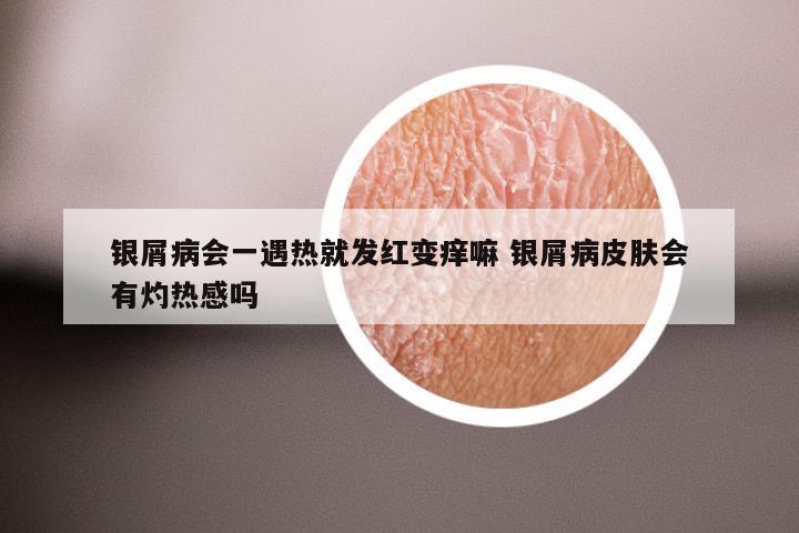 银屑病会一遇热就发红变痒嘛 银屑病皮肤会有灼热感吗