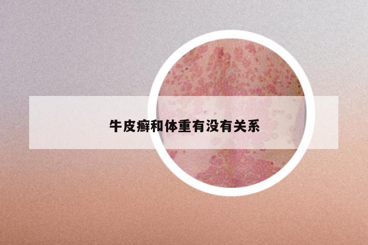 牛皮癣和体重有没有关系