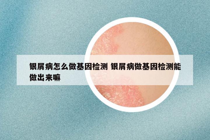 银屑病怎么做基因检测 银屑病做基因检测能做出来嘛