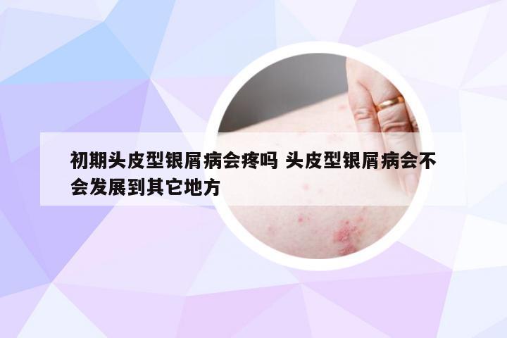 初期头皮型银屑病会疼吗 头皮型银屑病会不会发展到其它地方