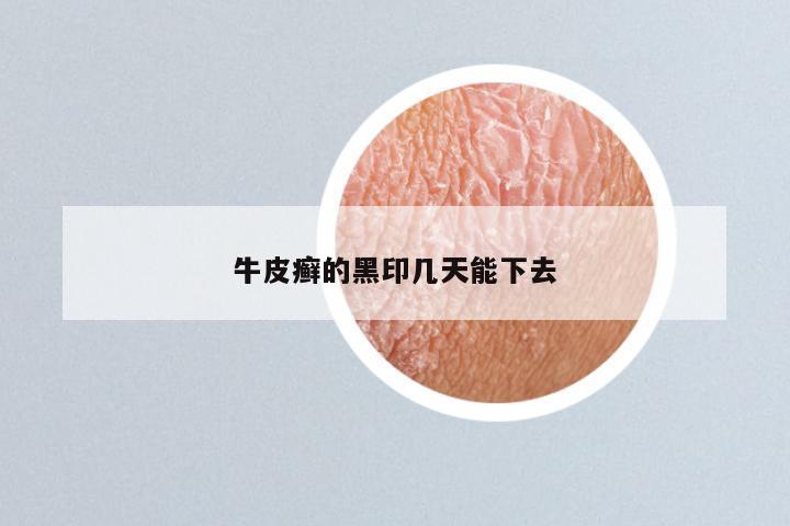 牛皮癣的黑印几天能下去