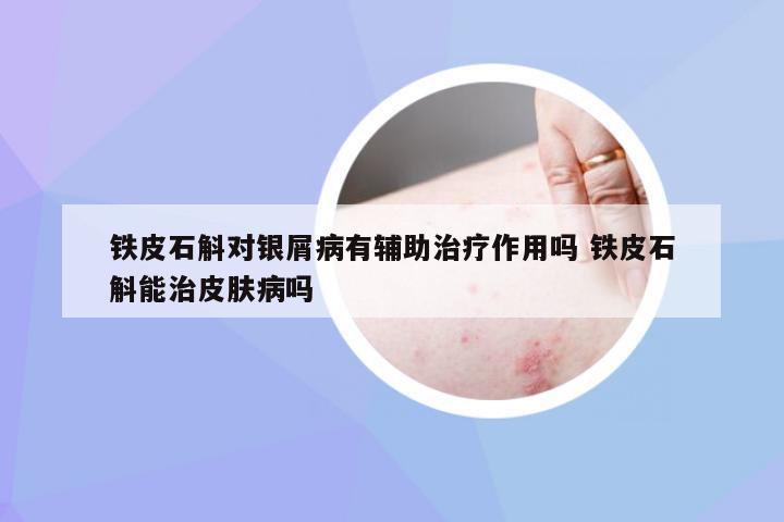 铁皮石斛对银屑病有辅助治疗作用吗 铁皮石斛能治皮肤病吗
