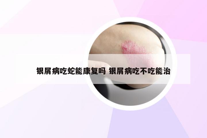 银屑病吃蛇能康复吗 银屑病吃不吃能治