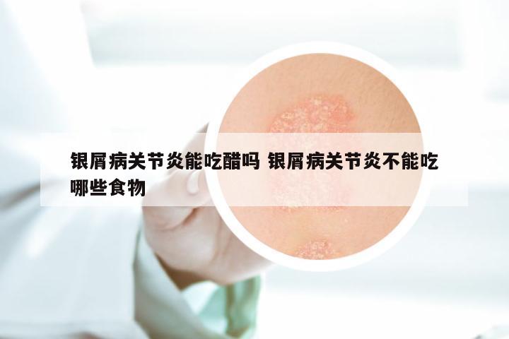 银屑病关节炎能吃醋吗 银屑病关节炎不能吃哪些食物