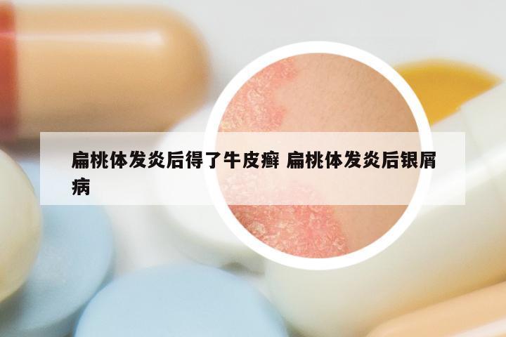 扁桃体发炎后得了牛皮癣 扁桃体发炎后银屑病