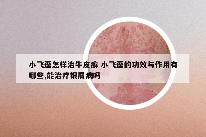 小飞蓬怎样治牛皮癣 小飞蓬的功效与作用有哪些,能治疗银屑病吗
