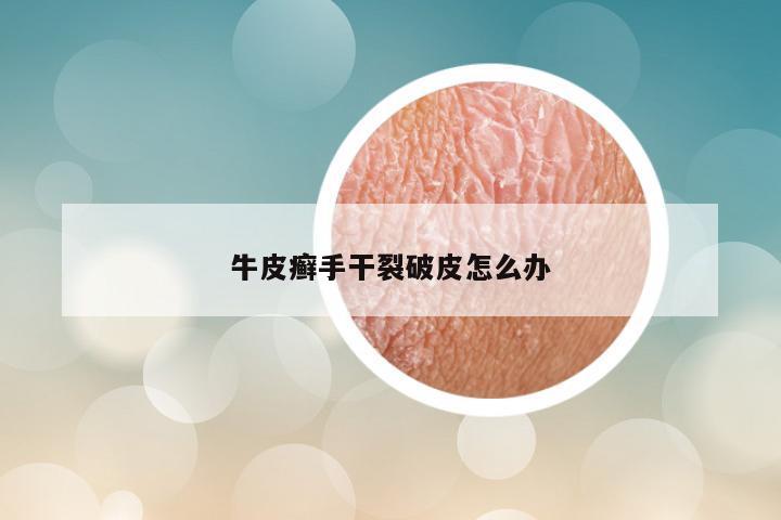 牛皮癣手干裂破皮怎么办