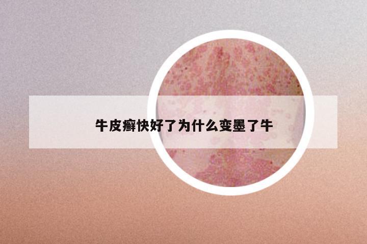 牛皮癣快好了为什么变墨了牛