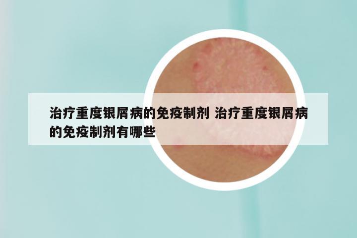 治疗重度银屑病的免疫制剂 治疗重度银屑病的免疫制剂有哪些