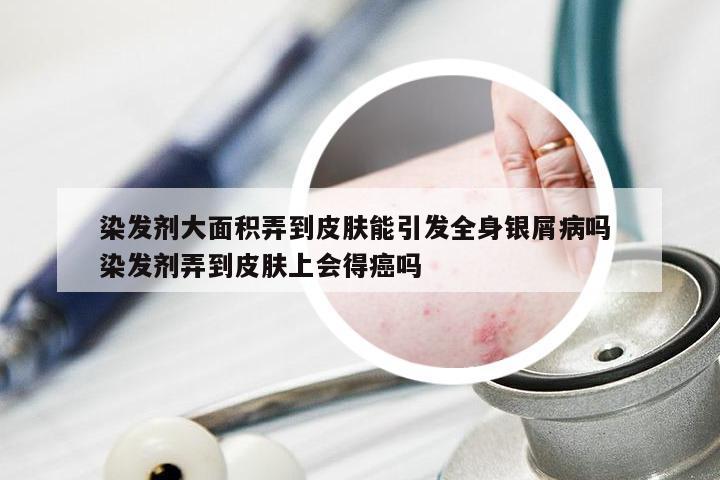 染发剂大面积弄到皮肤能引发全身银屑病吗 染发剂弄到皮肤上会得癌吗
