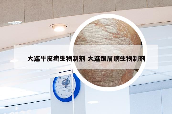 大连牛皮癣生物制剂 大连银屑病生物制剂