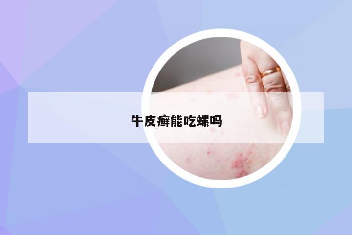 牛皮癣能吃螺吗
